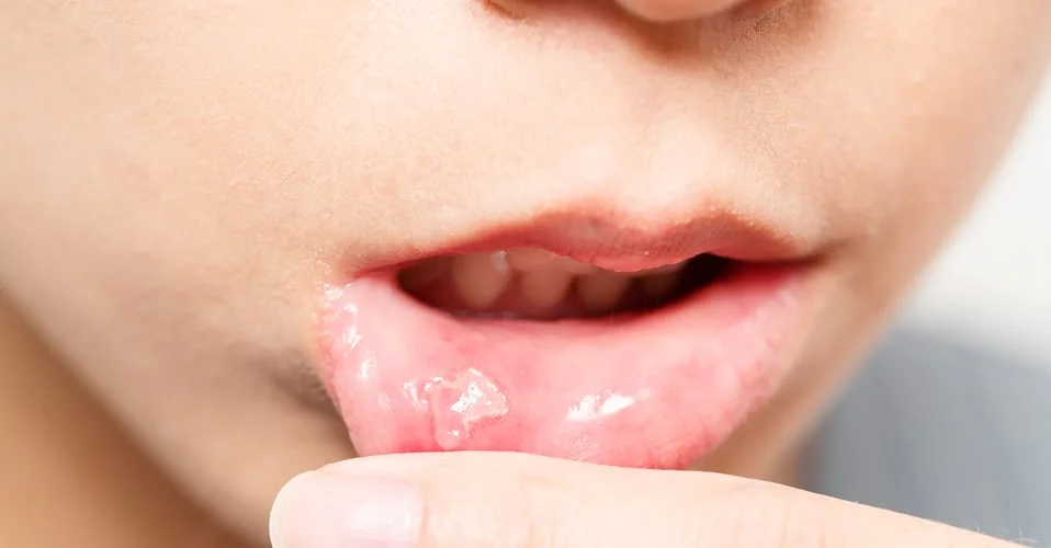 Homeopathic solutions for stomatitis